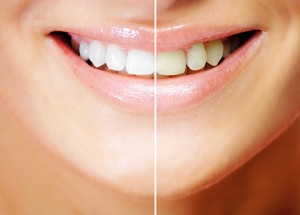 Каким образом зубы отбеливают? Гели для отбеливания зубов
