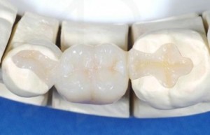Цельнокерамические вкладки на зубы