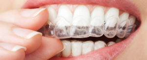 Особенность выравнивания зубов без брекетов