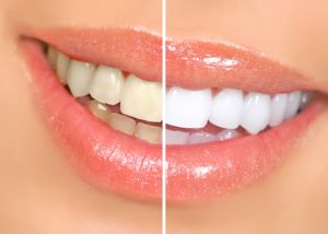 Чистка зубов и отбеливание. В чем разница?