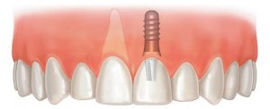 Забота о зубах после имплантации зуба
