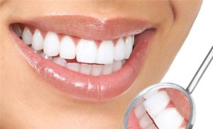 Зубные виниры - новое слово в стоматологии