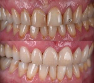 Композитная реставрация зубов