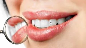 Зубные украшения в стоматологии
