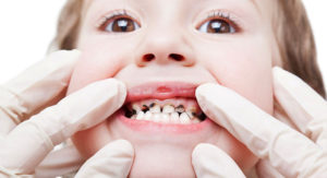 Что будет, если не лечить зубы?