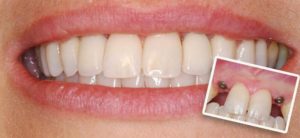 Про имплантацию зубов в два этапа