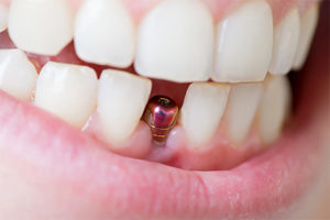 Имплантация зубов без разреза десны