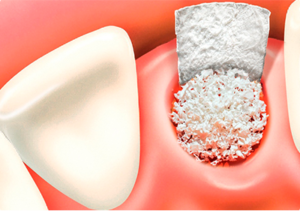 Синус-лифтинг в стоматологии