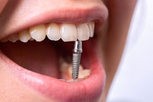 Имплантация зубов. Почему такая ценность?