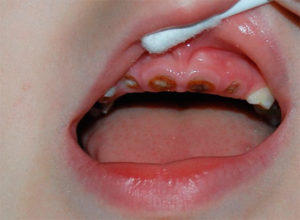 Нужно ли лечить молочные зубы у ребенка?