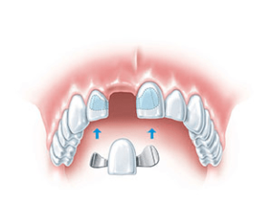 Временные протезы на зубы