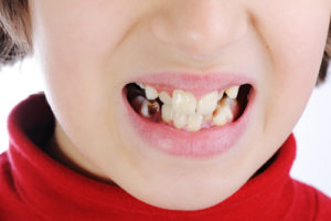 Адентия зубов