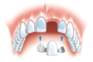 Адгезивный мост в стоматологии