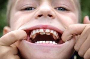 Почему у детей растут зубы неправильно?