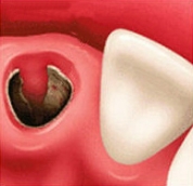 Альвеолит лунки после удаления зуба. Как избежать?