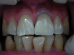 Зубы после установки безметалловой керамики