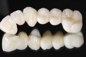 Протезирование зубов без металла