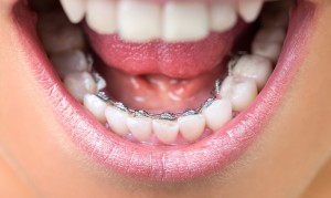 Брекеты и их виды в стоматологии