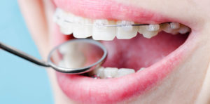 Виды брекетов в современной стоматологии