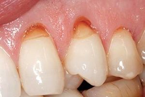 Клиновидный дефект зубов и основные причины