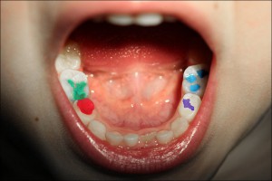 Пример цветных пломб на детских зубах