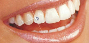 Установка и применение скайсов в стоматологии