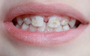 Фтор и кариес детских зубов