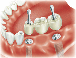 Что такое съемное и несъемное протезирование зубов?
