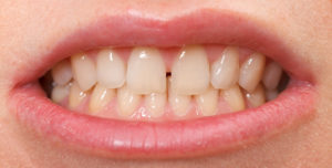 Методы устранения щели между зубами