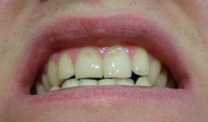 Эрозия зубов. Что это такое?