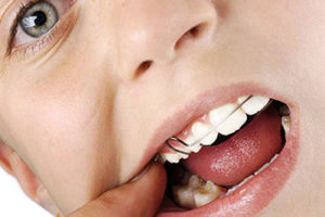 Как носить и ухаживать за ортодонтическими пластинками?