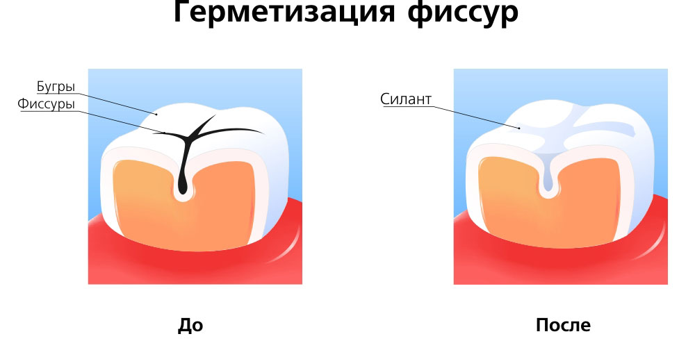 Запечатывание фиссур зубов ребенку Запечатывание фиссур зубов ребенку