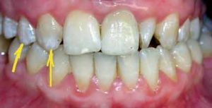 Флюороз эмали зубов