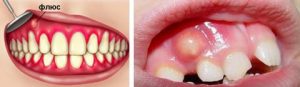 Флюс зубной и способы лечения