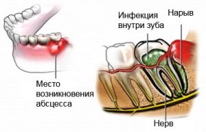 Лечение зубного флюса