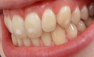 Формы флюороза зубов