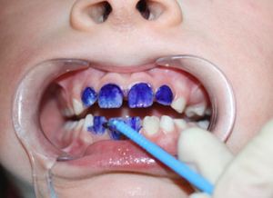 Фторирование молочных зубов у детей