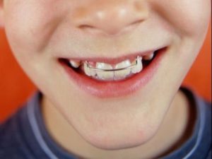 Пластинки на зубы детям и подросткам