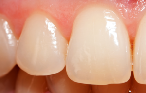 Как лечится трещина в эмали зуба?
