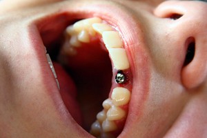 Имплантация зубов - это залог красоты