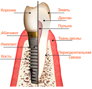 Общая информация про имплантацию зубов