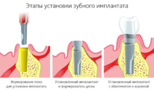 В чем главная проблема имплантации зубов?