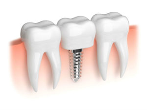 Часто задаваемые вопросы об имплантации зубов