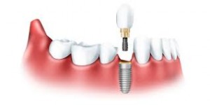 Имплантация зубов - сочетние всех преимуществ протезирования