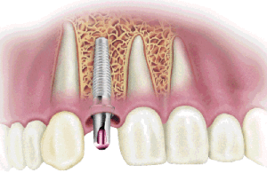 Имплантация и третья жизнь зубов