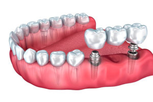 А что Вы знаете про зубные импланты?