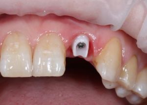 Передние зубы и имплантация