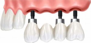 Преимущества базальной имплантации зубов