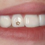 Инкрустация зубов