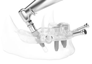 Противопоказания и преимущества экспресс-имплантации зубов